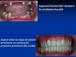 Aspect clinic la etapa de șinare
provizorie cu construcții
protetice provizorii din acrilat
Aspectul bonturilor dentare
în cavitatea bucală
 