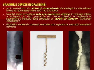 SPASMELE DIFUZE ESOFAGIENE:
• sunt caracterizate prin contracții necoordonate ale esofagului și este adesea
însoțit de regurgitarea alimentelor sau a lichidelor.
• tranzitul baritat evidențiază unde non-propulsive, etajate, în regiunea netedă
a esofagului, iar când contracțiile sunt foarte puternice se realizează o
segmentare a bolusului dând esofagului un aspect de tirbușon (“corkscrew
esophagus”).
• deglutițiile urmate de contracții anormale sunt separate de contracții peristaltice
normale;
 
