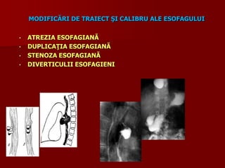MODIFICĂRI DE TRAIECT ŞI CALIBRU ALE ESOFAGULUI
• ATREZIA ESOFAGIANĂ
• DUPLICAŢIA ESOFAGIANĂ
• STENOZA ESOFAGIANĂ
• DIVERTICULII ESOFAGIENI
 