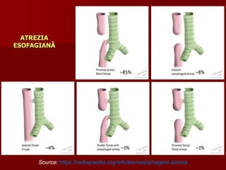 ATREZIA
ESOFAGIANĂ
Source: https://radiopaedia.org/articles/oesophageal-atresia
 