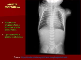 ATREZIA
ESOFAGIANĂ
Source: https://radiopaedia.org/articles/oesophageal-atresia
• Tubul naso /
orogastric face o
buclă mai sus de
locul atreziei.
• Lipsa completă a
gazelor în abdomen.
 
