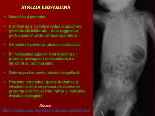 ATREZIA ESOFAGIANĂ
Source:
https://radiopaedia.org/articles/oesophageal-atresia
• Nou-născut prematur.
• Plămânii apar cu volum redus și opacifiere
generalizată bilaterală – date suggestive
pentru sindromul de detresă respiratorie.
• Se observă prezența tubului endotracheal.
• În mediastinul superior linia mediană (în
proiecția esofagului) se vizualizează o
structură cu conținut aeric.
• Date sugestive pentru atrezie esogafiană.
• Prezența conținutului gazos în stomac și
intestinul subțire sugerează de asemenea
prezența unei fistule între trahee și porțiunea
distală a esofagului.
 