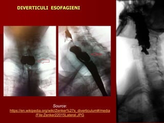 Source:
https://en.wikipedia.org/wiki/Zenker%27s_diverticulum#/media
/File:Zenker22015Lateral.JPG
DIVERTICULI ESOFAGIENI
 