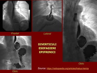Source: https://radiopaedia.org/articles/hiatus-hernia
DIVERTICULI
ESOFAGIENI
EPIFRENICI
Frontal Lateral
Oblic
Oblic
 