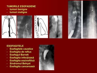TUMORILE ESOFAGIENE
- tumori benigne
- tumori maligne
ESOFAGITELE
- Esofagitele caustice
- Esofagita de reflux
- Esofagul Barrett
- Esofagita infecțioasă
- Esofagita eozinofilică
- Sindromul Behçet
- Esofagita canceroasă
 