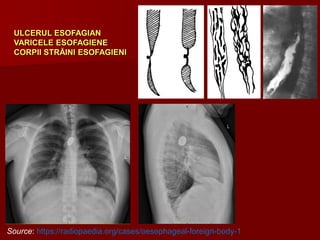 ULCERUL ESOFAGIAN
VARICELE ESOFAGIENE
CORPII STRĂINI ESOFAGIENI
Source: https://radiopaedia.org/cases/oesophageal-foreign-body-1
 