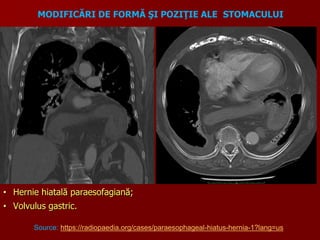 • Hernie hiatală paraesofagiană;
• Volvulus gastric.
Source: https://radiopaedia.org/cases/paraesophageal-hiatus-hernia-1?lang=us
MODIFICĂRI DE FORMĂ ŞI POZIŢIE ALE STOMACULUI
 