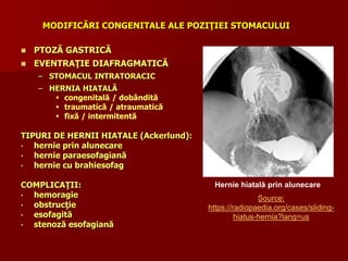 MODIFICĂRI CONGENITALE ALE POZIŢIEI STOMACULUI
 PTOZĂ GASTRICĂ
 EVENTRAŢIE DIAFRAGMATICĂ
– STOMACUL INTRATORACIC
– HERNIA HIATALĂ
 congenitală / dobândită
 traumatică / atraumatică
 fixă / intermitentă
TIPURI DE HERNII HIATALE (Ackerlund):
• hernie prin alunecare
• hernie paraesofagiană
• hernie cu brahiesofag
COMPLICAŢII:
• hemoragie
• obstrucţie
• esofagită
• stenoză esofagiană
Hernie hiatală prin alunecare
Source:
https://radiopaedia.org/cases/sliding-
hiatus-hernia?lang=us
 