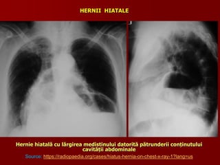 Hernie hiatală cu lărgirea medistinului datorită pătrunderii conținutului
cavității abdominale
Source: https://radiopaedia.org/cases/hiatus-hernia-on-chest-x-ray-1?lang=us
HERNII HIATALE
 