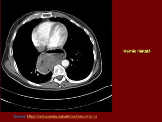 Hernie hiatală
Source: https://radiopaedia.org/articles/hiatus-hernia
 