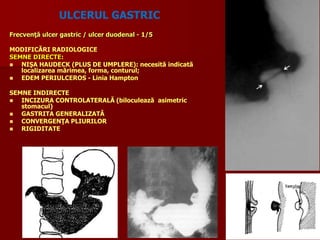 ULCERUL GASTRIC
Frecvenţă ulcer gastric / ulcer duodenal - 1/5
MODIFICĂRI RADIOLOGICE
SEMNE DIRECTE:
 NIŞA HAUDECK (PLUS DE UMPLERE): necesită indicată
localizarea mărimea, forma, conturul;
 EDEM PERIULCEROS - Linia Hampton
SEMNE INDIRECTE
 INCIZURA CONTROLATERALĂ (biloculează asimetric
stomacul)
 GASTRITA GENERALIZATĂ
 CONVERGENŢA PLIURILOR
 RIGIDITATE
 