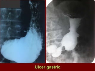 Ulcer gastric
 