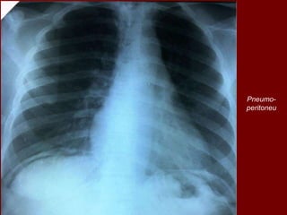 Pneumo-
peritoneu
 