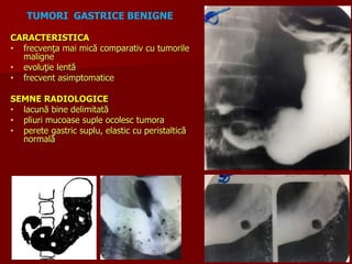 CARACTERISTICA
• frecvenţa mai mică comparativ cu tumorile
maligne
• evoluţie lentă
• frecvent asimptomatice
SEMNE RADIOLOGICE
• lacună bine delimitată
• pliuri mucoase suple ocolesc tumora
• perete gastric suplu, elastic cu peristaltică
normală
TUMORI GASTRICE BENIGNE
 