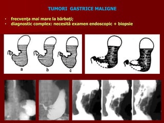 • frecvenţa mai mare la bărbaţi;
• diagnostic complex: necesită examen endoscopic + biopsie
TUMORI GASTRICE MALIGNE
 