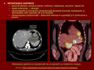  METASTAZELE GASTRICE
– punct de plecare: cancerul mamar, limfomul, melanomul, sarcomul Kaposi etc
– noduli submucoşi → ulceraţii;
– ultrasonografia și tomografia computerizată decelează prezenţa metastazelor şi
adenopatiilor atât regionale cât şi la distanţă;
– ultrasonografia endoluminală – determină extensia în suprafaţă şi în profunzime a
tumorii.
Metastaze gastrice și duodenale la un pacient cu melanom malign.
Source: https://radiopaedia.org/cases/melanoma-gastrointestinal-metastases
 