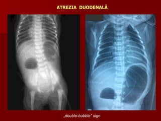 ATREZIA DUODENALĂ
„double-bubble” sign
 