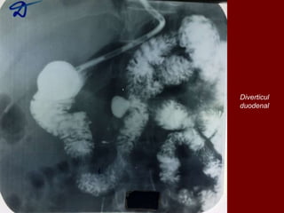 Diverticul
duodenal
 