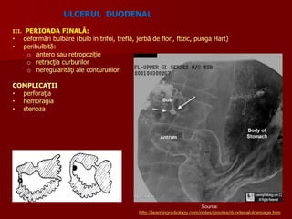 III. PERIOADA FINALĂ:
• deformări bulbare (bulb în trifoi, treflă, jerbă de flori, ftizic, punga Hart)
• peribulbită:
o antero sau retropoziţie
o retracţia curburilor
o neregularităţi ale contururilor
COMPLICAŢII
• perforaţia
• hemoragia
• stenoza
ULCERUL DUODENAL
Source:
http://learningradiology.com/notes/ginotes/duodenalulcerpage.htm
 