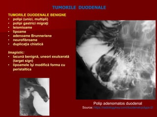 TUMORILE DUODENALE BENIGNE
• polipi (unici, multipli)
• polipi gastrici migraţi
• leiomioame
• lipoame
• adenoame Brunneriene
• neurofibroame
• duplicaţia chistică
Imagistic:
• lacună benignă, uneori exulcerată
(target sign)
• lipoamele îşi modifică forma cu
peristaltica
TUMORILE DUODENALE
Polip adenomatos duodenal
Source: https://radiologykey.com/duodenal-polyps-2/
 