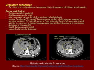 METASTAZE DUODENALE
• De obicei prin contiguitate de la organele din jur (pancreas, căi biliare, antrul gastric)
Semne radiologice:
• lărgirea cadrului duodenal
• rigiditatea conturului intern
• pliuri mucoase care se termină brusc (semnul rabotajului)
• semnul Frostberg (”3 inversat” la o examenul baritat): distorsiunea mucoasei pe
peretele medial în D2 datorită masei și / sau edemului local. Este cel mai frecvent
asociat cu carcinom al capului pancreasului, dar poate fi observat și în carcinomul
duodenal și pancreatită)
• fistulă duodeno-pancreatică
• stenoză a lumenului duodenal
Metastaze duodenale în melanom.
Source: https://radiopaedia.org/cases/melanoma-gastrointestinal-metastases
 