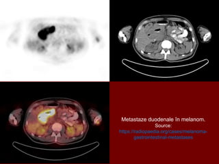 Metastaze duodenale în melanom.
Source:
https://radiopaedia.org/cases/melanoma-
gastrointestinal-metastases
 
