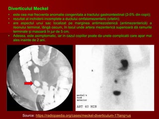Source: https://radiopaedia.org/cases/meckel-diverticulum-1?lang=us
Diverticulul Meckel
• este cea mai frecventa anomalie congenitala a tractului gastrointestinal (2-5% din copii);
• rezultat al inchiderii incomplete a ductului omfalomezenteric (vitelin);
• are aspectul unui sac localizat pe marginea antimezostenică (antimezenterică) a
ileonului terminal, lângă cecum, în locul unde artera mezenterică superioară dă ramurile
terminale și masoară în jur de 5 cm;
• Adesea, este asimptomatic, iar in cazul copiilor poate da unele complicatii care apar mai
ales inainte de 2 ani.
 