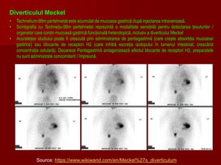 Source: https://www.wikiwand.com/en/Meckel%27s_diverticulum
Diverticulul Meckel
• Technetium-99m pertehnetat este acumulat de mucoasa gastrică după injectarea intravenoasă.
• Scintigrafia cu Technețiu-99m pertehnetat reprezintă o modalitate sensibilă pentru detectarea țesuturilor /
organelor care conțin mucoasă gastrică funcțională heterotopică, inclusiv a diverticului Meckel
• Acuratețea studiului poate fi crescută prin administrarea de pentagastrină (care crește absorbția mucoasei
gastrice) sau blocante de receptori H2 (care inhibă excreția izotopului în lumenul intestinal, crescând
concentrația celulară). Deoarece Pentagastrină antagonizează efectul blocante de receptori H2, preparatele
nu sunt administrate concomitent / împreună.
 