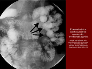 Examen baritat al
intestinului subțire
demonstrând
diverticuloza jejunală
Source: Alex Mortimer et al.
Jejunal diverticulitis: an unusual
cause of an intra-abdominal
abscess. Journal of Radiology
Case Reports. 2008, 2(5):15-8
 