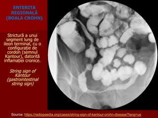 Strictură a unui
segment lung de
ileon terminal, cu o
configurație de
cordon (semnul
Kantour), datorită
inflamației cronice.
String sign of
Kantour
(gastrointestinal
string sign)
ENTERITA
REGIONALĂ
(BOALA CROHN)
Source: https://radiopaedia.org/cases/string-sign-of-kantour-crohn-disease?lang=us
 