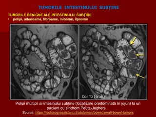 TUMORILE BENIGNE ALE INTESTINULUI SUBȚIRE
• polipi, adenoame, fibroame, mioame, lipoame
TUMORILE INTESTINULUI SUBȚIRE
Polipi multipli ai intesinului subține (localizare predominată în jejun) la un
pacient cu sindrom Peutz-Jeghers
Source: https://radiologyassistant.nl/abdomen/bowel/small-bowel-tumors
 