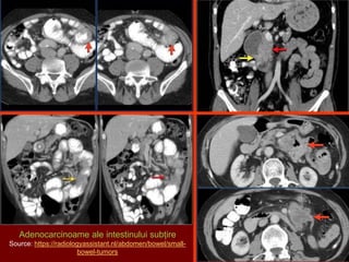 Adenocarcinoame ale intestinului subțire
Source: https://radiologyassistant.nl/abdomen/bowel/small-
bowel-tumors
 