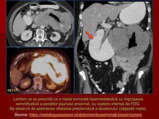 Limfom ce se prezintă ca o masă tumorală hipermetabolică cu îngroșarea
semnificativă a pereților jejunului proximal, cu captare intensă de FDG.
Se observă de asemenea dilatarea prestenotică a duodenului (săgeată roșie).
Source: https://radiologyassistant.nl/abdomen/bowel/small-bowel-tumors
 