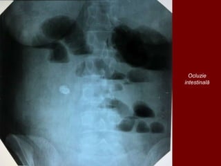 Ocluzie
intestinală
 