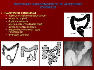  MALFORMAŢII CONGENITALE
– absenţa rotaţiei (mezenterul comun)
– rotaţia incompletă
– duplicaţia colonului
– atrezia anală (imperforaţia anală)
– atrezia şi stenoza colonului
– megacolonul congenital (boala
Hirschsprung)
– diverticolii colonului
MODIFICĂRI RADIOIMAGISTICE ÎN AFECȚIUNILE
COLONULUI
 