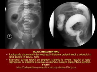BOALA HIRSCHSPRUNG
– Radiografia abdominală demonstrează dilatarea proieminentă a colonului și
lipsa gazului în pelvis / rect;
– Examenul baritat relevă un segment stenotic la nivelul rectului și recto-
sigmoidului cu dilatarea proximală a colonului înaintea segmentului stenotic.
Source:
https://radiopaedia.org/cases/hirschsprung-disease-1?lang=us
 