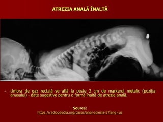 • Umbra de gaz rectală se află la peste 2 cm de markerul metalic (poziția
anusului) - date sugestive pentru o formă înaltă de atrezie anală.
Source:
https://radiopaedia.org/cases/anal-atresia-3?lang=us
ATREZIA ANALĂ ÎNALTĂ
 