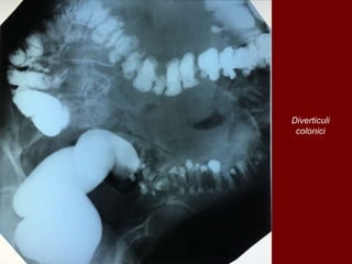 Diverticuli
colonici
 