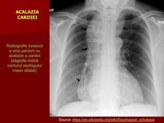 ACALAZIA
CARDIEI
Radiografie toracică
a unui pacient cu
acalazie a cardiei
(săgețile indică
conturul esofagului
masiv dilatat)
Source: https://en.wikipedia.org/wiki/Esophageal_achalasia
 