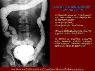 RECTOCOLITA ULCERO-HEMORAGICĂ
(COLITA ULCERATIVĂ)
• modificări ale mucoasei - aspect granular
datorită ulceraţiilor superficiale şi insulelor
de edem al mucoasei;
• dispariţia haustrelor;
• dispariţia falturilor dintre haustre;
• afectarea continuă a întregului colon este
sugestivă pentru colita ulceroasă;
• se observă de asemenea insuficiența
valvei ileocecale (datorită procesului
inflamator cronic) cu trecerea retrogradă a
contrastului baritat din cec în ileon.
Source: https://radiopaedia.org/cases/ulcerative-colitis-barium-enema
 