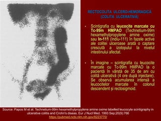 RECTOCOLITA ULCERO-HEMORAGICĂ
(COLITA ULCERATIVĂ)
• Scintigrafia cu leucocite marcate cu
Tc-99m HMPAO (Technetium-99m
hexamethylpropylene amine oxime)
sau In-111 (Indiu-111) în fazele active
ale colitei ulceroase arată o captare
crescută a izotopului la nivelul
intestinului afectat.
• În imagine – scintigrafia cu leucocite
marcate cu Tc-99m HMPAO la o
pacientă în vârstă de 35 de ani cu
colită ulcerativă (4 ore după injectare).
Se observă acumularea intensă a
leucocitelor marcate în colonul
descendent și rectosigmoid.
Source: Papos M et al. Technetium-99m hexamethylpropylene amine oxime labelled leucocyte scintigraphy in
ulcerative colitis and Crohn's diseas. Eur J Nucl Med. 1993 Sep;20(9):766
https://pubmed.ncbi.nlm.nih.gov/8223770/
 