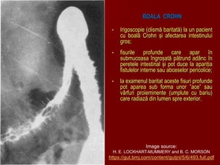 BOALA CROHN
• Irigoscopie (clismă baritată) la un pacient
cu boală Crohn și afectarea intestinului
gros;
• fisurile profunde care apar în
submucoasa îngroșată pătrund adânc în
peretele intestinal și pot duce la apariția
fistulelor interne sau abceselor pericolice;
• la examenul baritat aceste fisuri profunde
pot aparea sub forma unor ”ace” sau
vârfuri proieminente (umplute cu bariu)
care radiază din lumen spre exterior.
Image source:
H. E. LOCKHART-MUMMERY and B. C. MORSON
https://gut.bmj.com/content/gutjnl/5/6/493.full.pdf
 