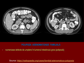 POLIPOZA ADENOMATOASĂ FAMILIALĂ
• numeroase defecte de umplere în lumenul intestinului gros (polipoză);
Source: https://radiopaedia.org/cases/familial-adenomatous-polyposis
 