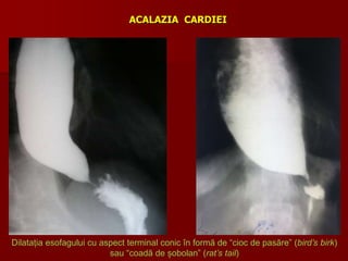 ACALAZIA CARDIEI
Dilatația esofagului cu aspect terminal conic în formă de “cioc de pasăre” (bird’s birk)
sau “coadă de șobolan” (rat’s tail)
 