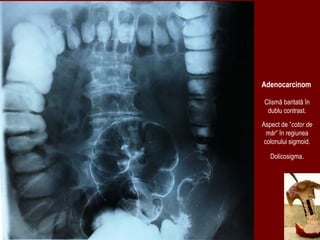 Clismă baritată în
dublu contrast.
Aspect de ”cotor de
măr” în regiunea
colonului sigmoid.
Dolicosigma.
Adenocarcinom
 