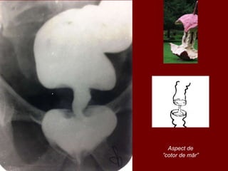 Aspect de
”cotor de măr”
 