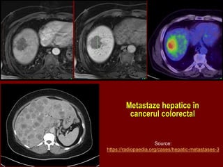 Metastaze hepatice în
cancerul colorectal
Source:
https://radiopaedia.org/cases/hepatic-metastases-3
 