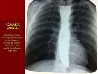 ACALAZIA
CARDIEI
Dilatația corpului
esofagian cu aspect
terminal conic,
în “cioc de pasăre”
(bird’s birk) sau
“coadă de șobolan”
(rat’s tail)
 