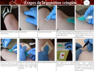 Étapes de la ponction veineuse S/A
 