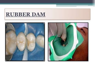 RUBBER DAM
 